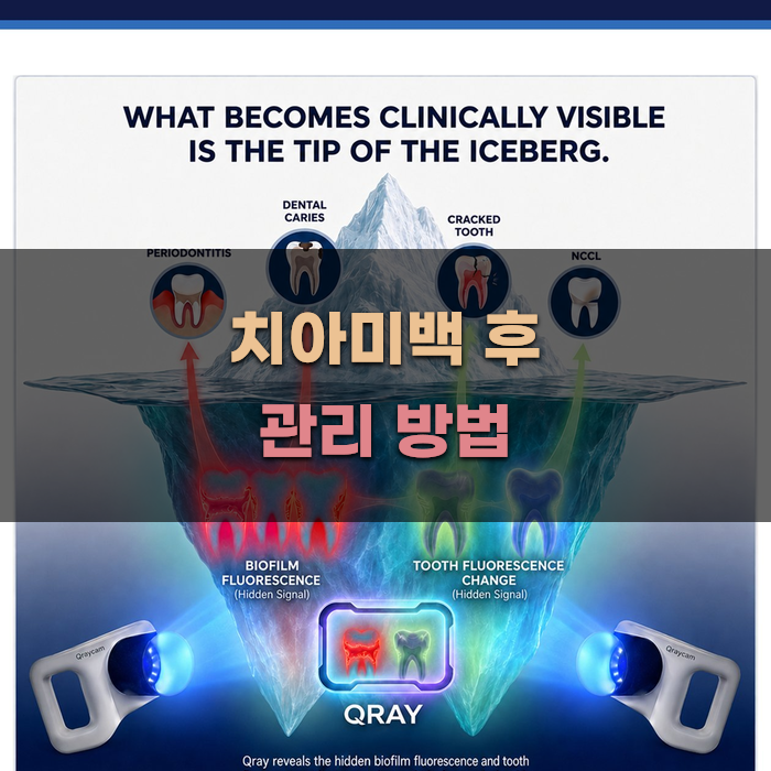 치아미백 후 관리 방법 안내