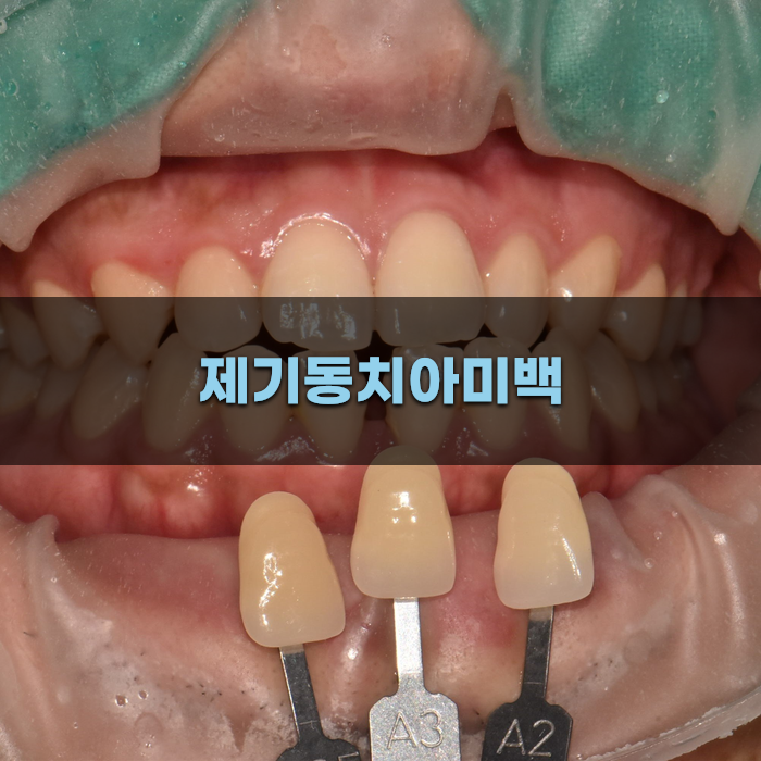 제기동치아미백의 효과와 과정