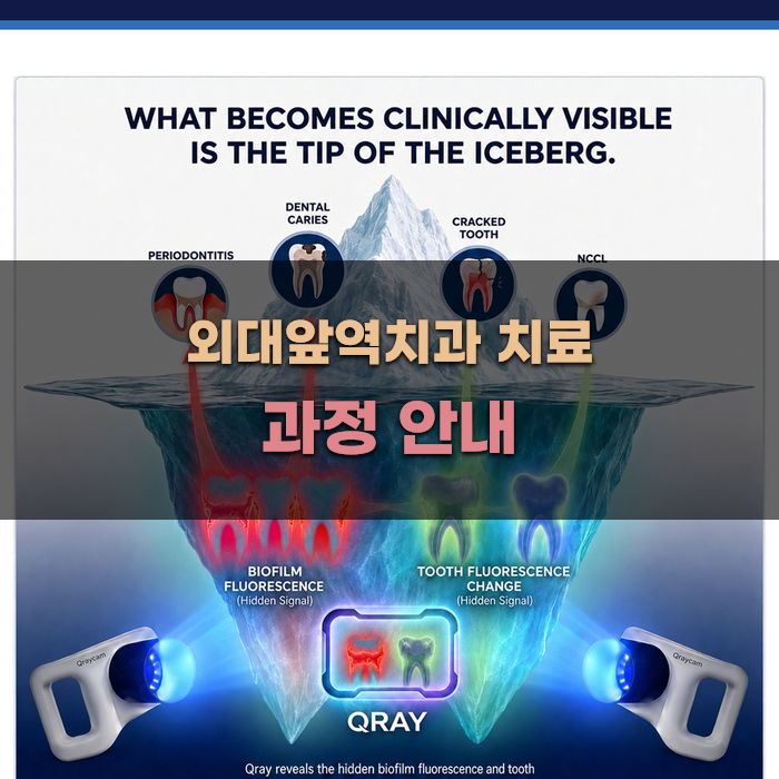 외대앞역치과 치료 과정 안내