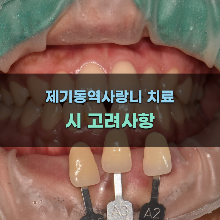 제기동역사랑니 치료 시 고려사항