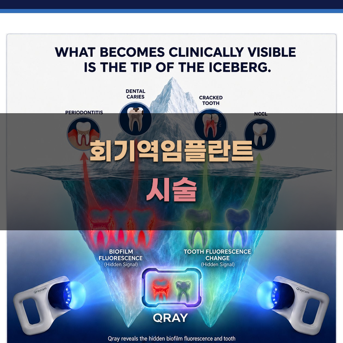 회기역임플란트 시술 과정 안내