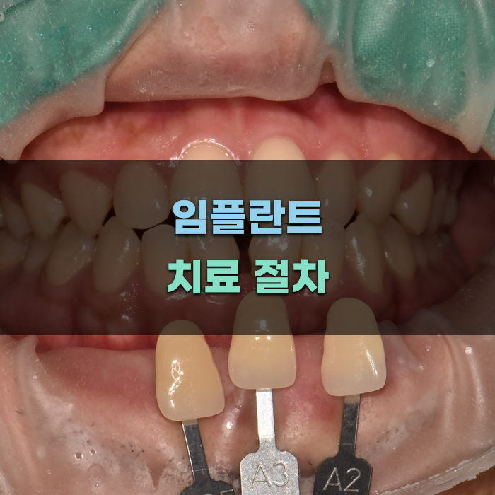 제기동 임플란트 치료 절차 안내