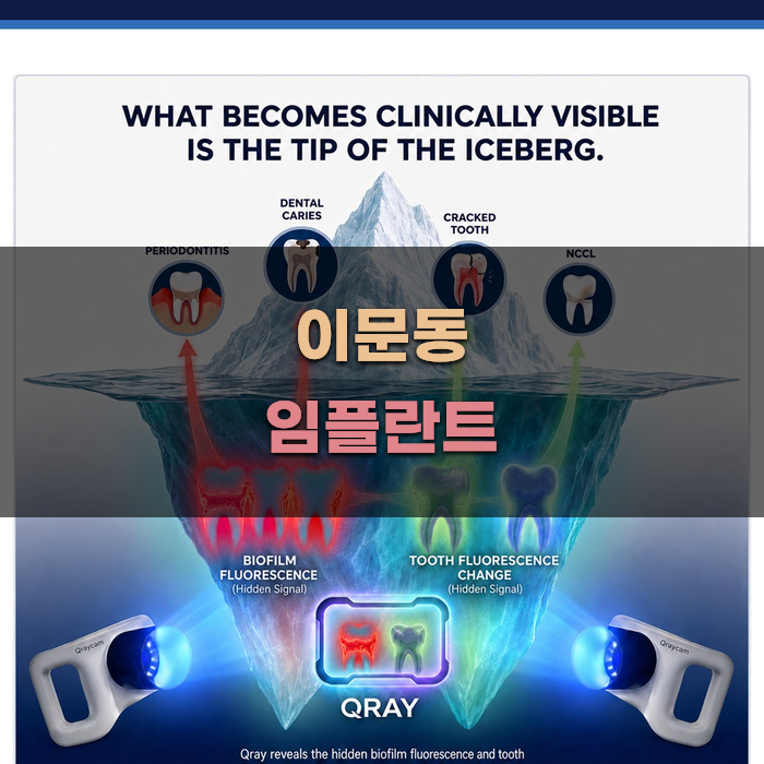 이문동 임플란트 선택 가이드