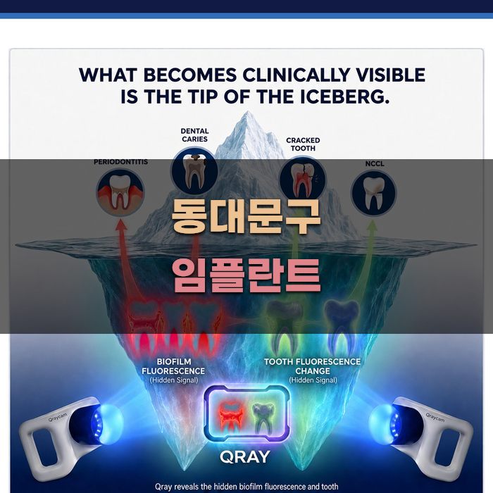 동대문구 임플란트 치료 과정 분석
