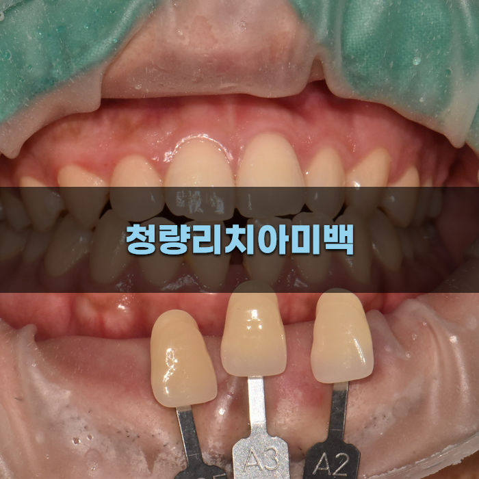 청량리치아미백을 위한 가이드