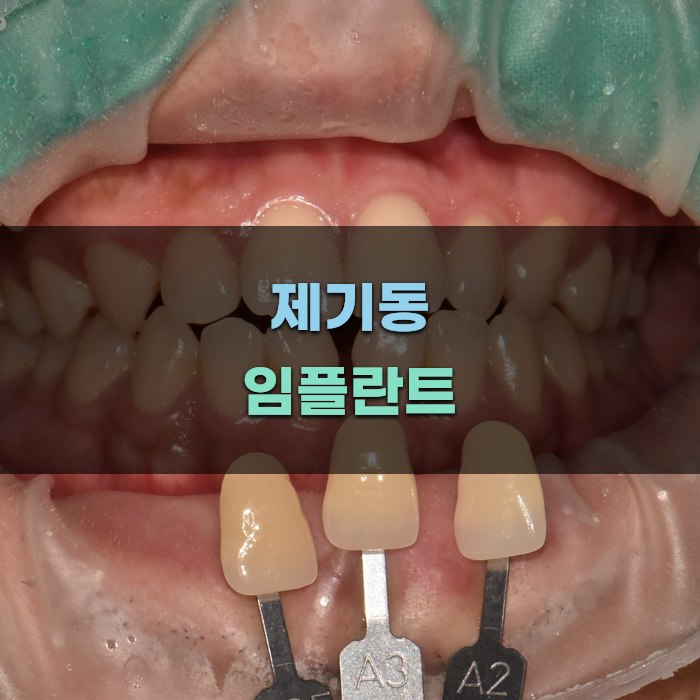 제기동 임플란트 치과 비교 분석