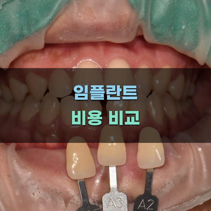 임플란트 비용 비교와 팁