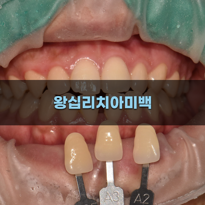 왕십리치아미백 효과와 방법